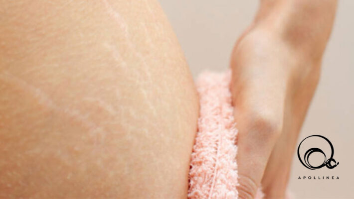 Smagliature: cause, rimedi e prevenzione