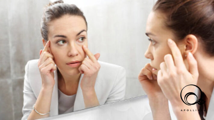 Occhiaie, cause e rimedi per eliminarle