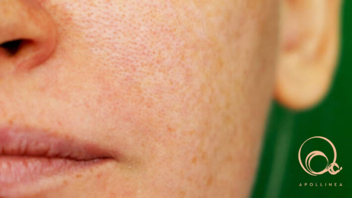 Pori dilatati: cosa fare per eliminarli