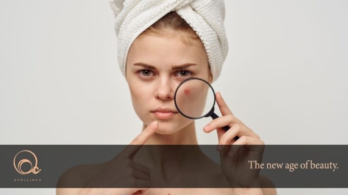 Acne? Curala con la bava di lumaca di Apollinea