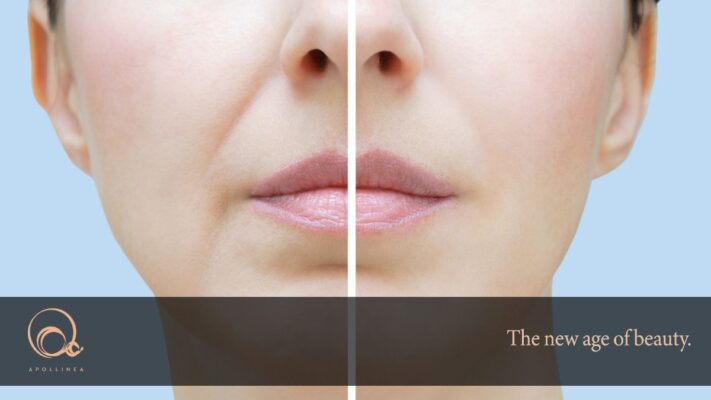 Rughe naso labiali: come eliminarle senza chirurgia