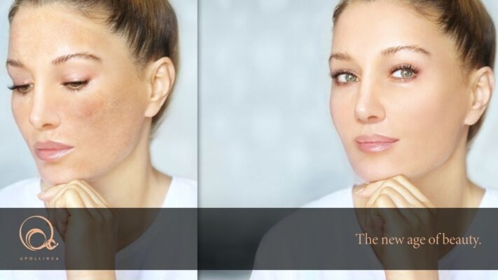 Macchie solari: 5 consigli di Apollinea per prevenirle