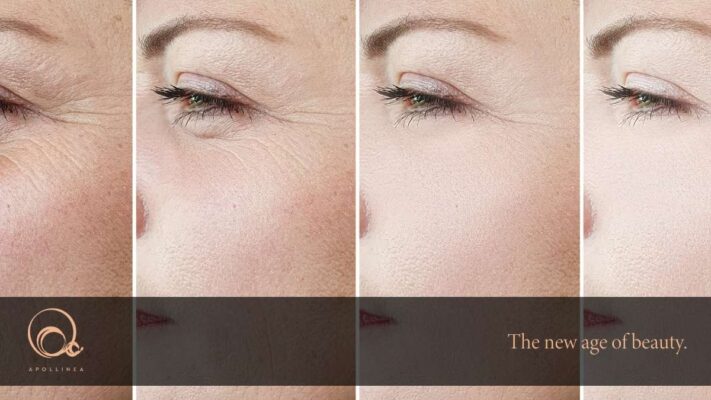 Rughe da stress: prevenzione e rimedi