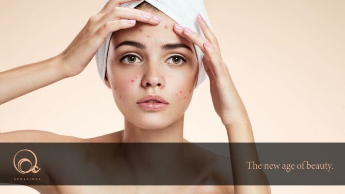 Brufoli da stress: eliminali con i prodotti naturali Apollinea!