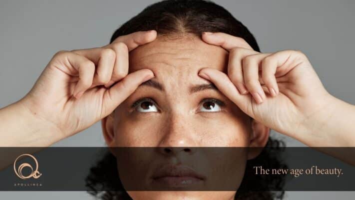 Rughe glabellari: perché si formano