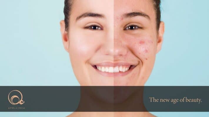 Acne giovanile: cause e come curarla