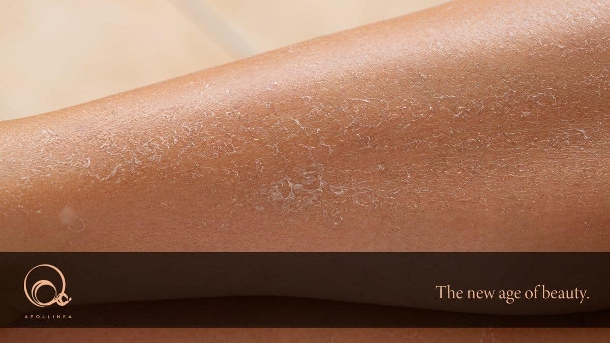 Pelle secca gambe in estate: cause e rimedi naturali